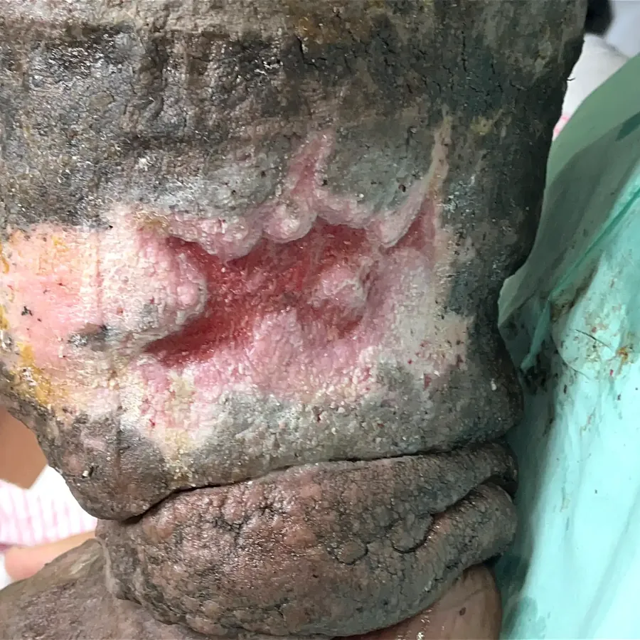 Clinical photograph of a lymphovascular leg wound at visit 2, HKL-11