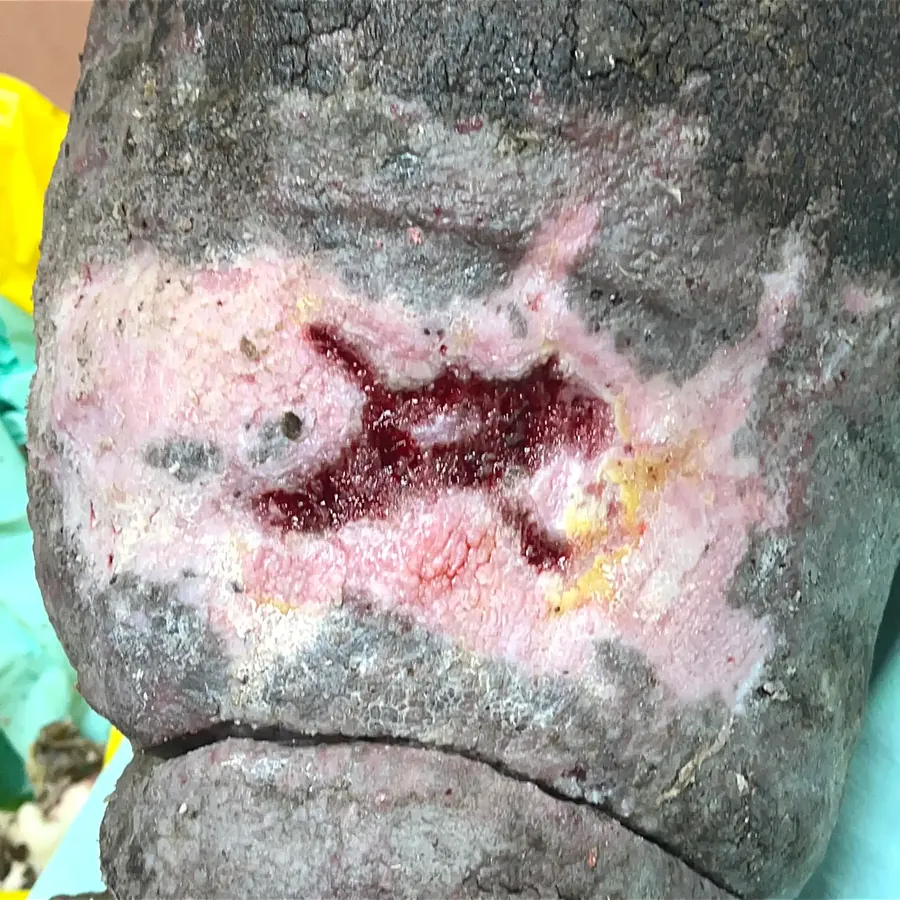 Clinical photograph of a lymphovascular leg wound at visit 3, HKL-11