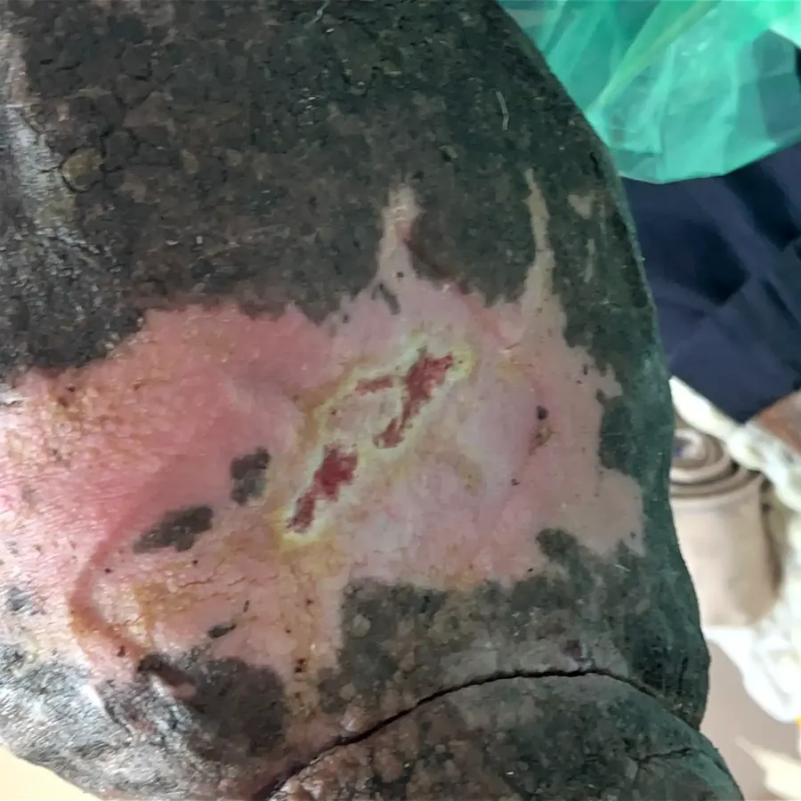 Clinical photograph of a lymphovascular leg wound at visit 4, HKL-11