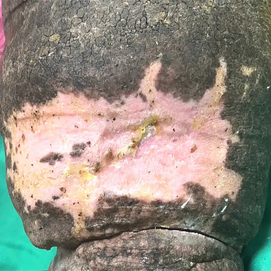 Clinical photograph of a lymphovascular leg wound at visit 5, HKL-11