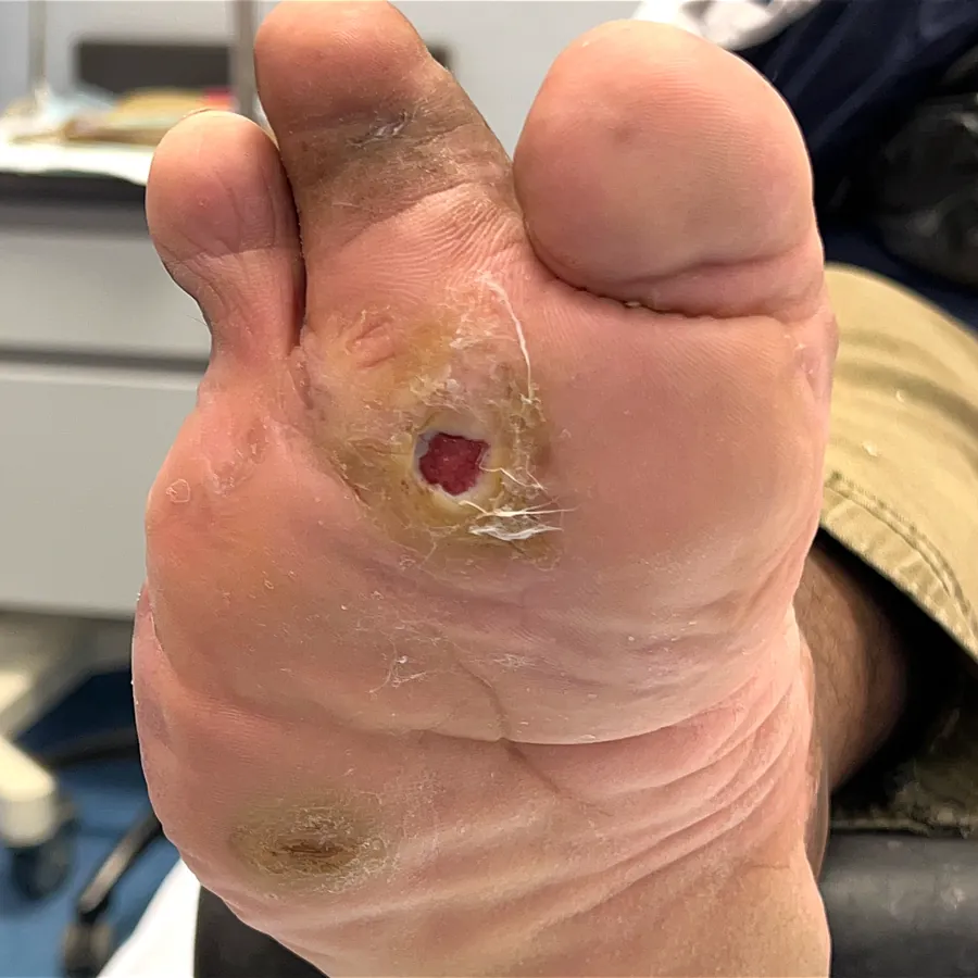 Clinical photograph of a diabetic plantar wound at visit 1, HKL-12