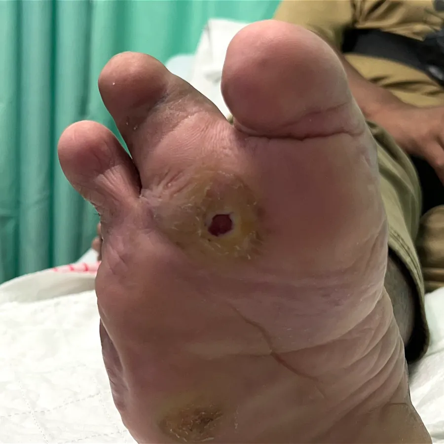 Clinical photograph of a diabetic plantar wound at visit 2, HKL-12