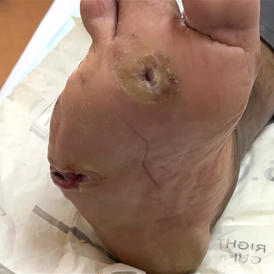 Clinical photograph of a diabetic plantar wound at visit 3, HKL-12