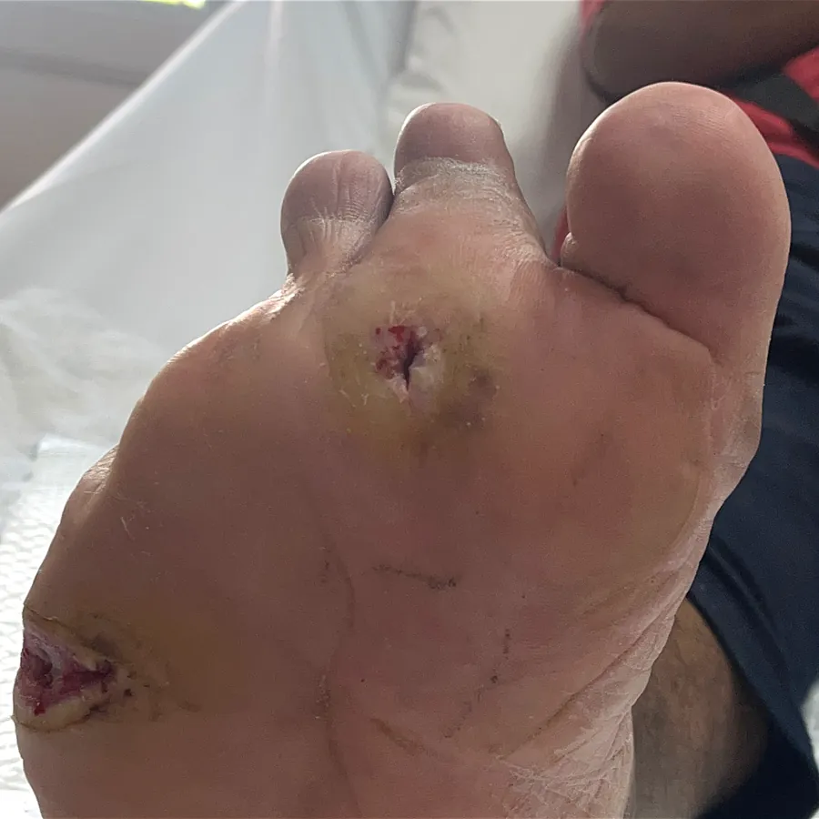 Clinical photograph of a diabetic plantar wound at visit 4, HKL-12