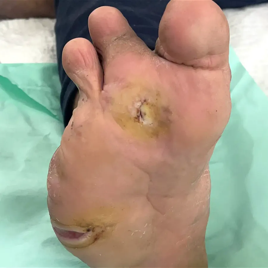 Clinical photograph of a diabetic plantar wound at visit 5, HKL-12
