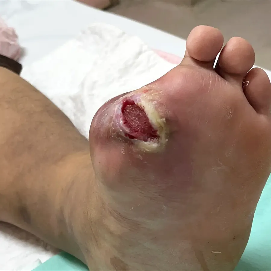 Clinical photograph of a diabetic plantar wound at visit 1, HKL-13