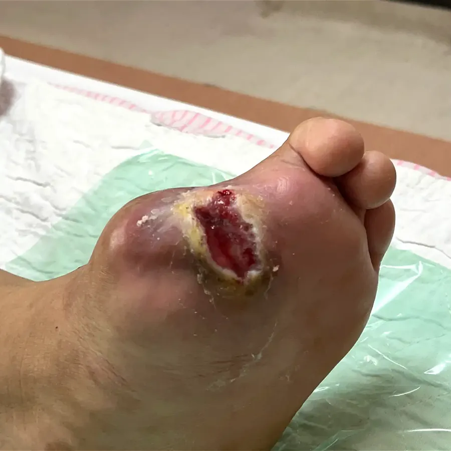 Clinical photograph of a diabetic plantar wound at visit 2, HKL-13