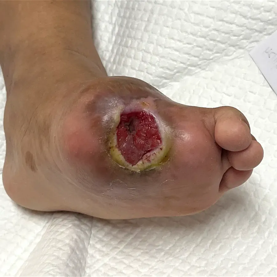 Clinical photograph of a diabetic plantar wound at visit 3, HKL-13