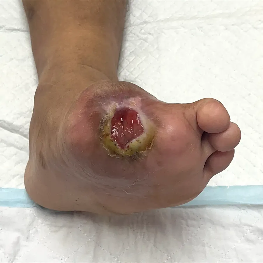 Clinical photograph of a diabetic plantar wound at visit 4, HKL-13