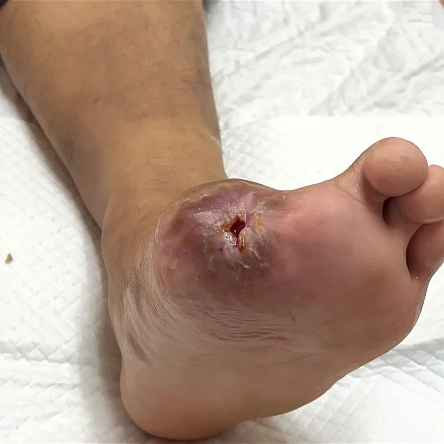 Clinical photograph of a diabetic plantar wound at visit 5, HKL-13