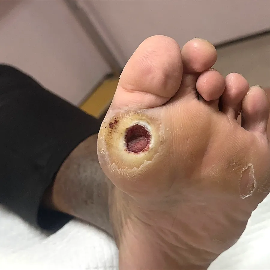 Clinical photograph of a diabetic plantar wound at visit 1, HKL-14
