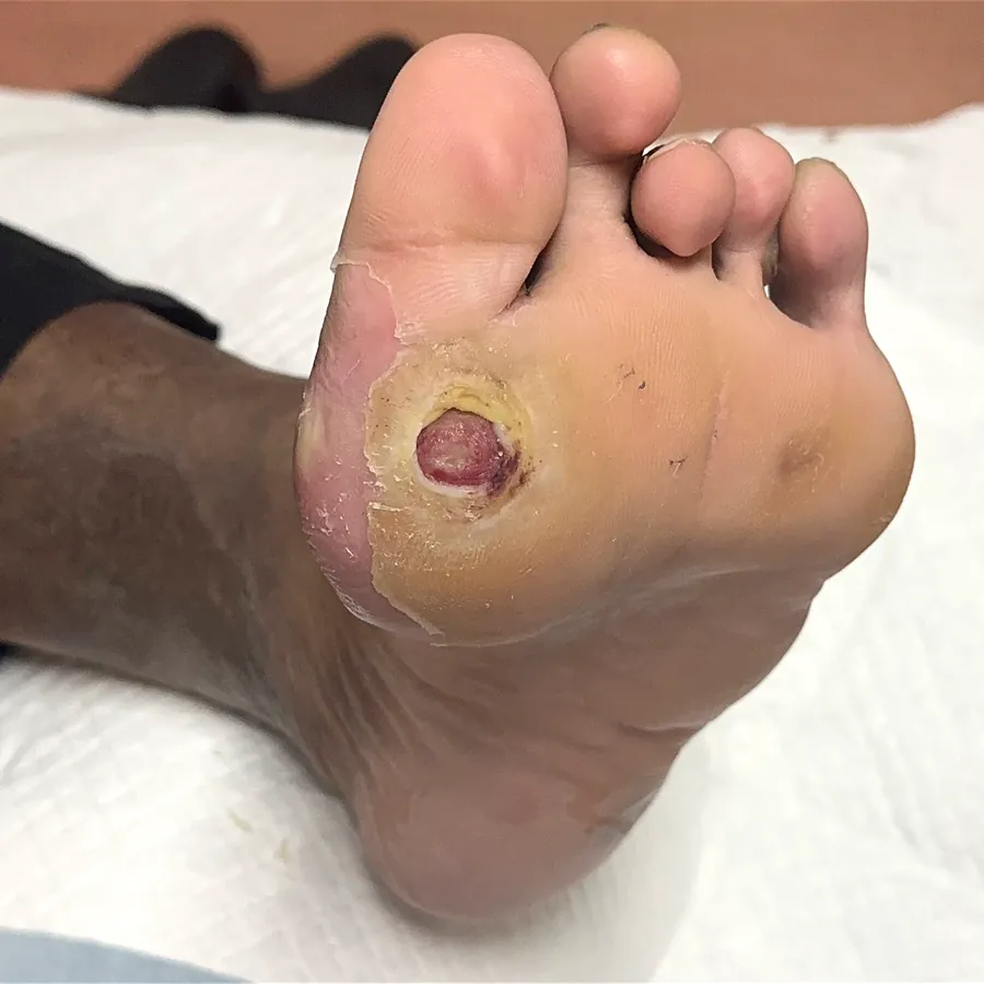 Clinical photograph of a diabetic plantar wound at visit 2, HKL-14