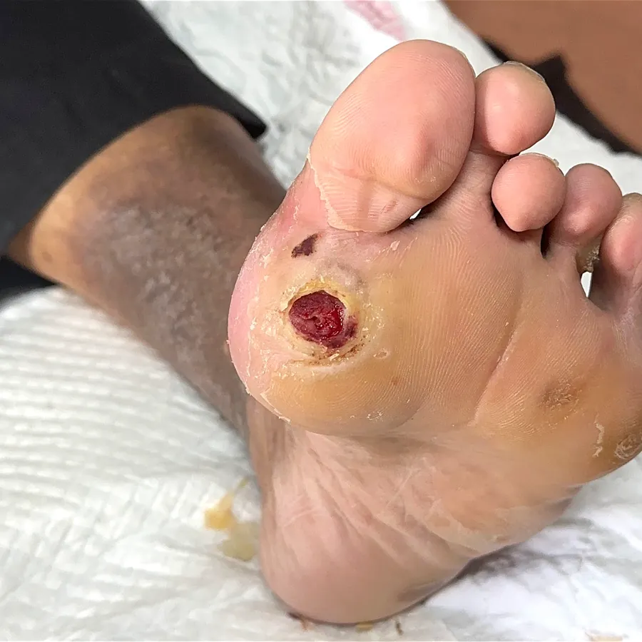Clinical photograph of a diabetic plantar wound at visit 3, HKL-14