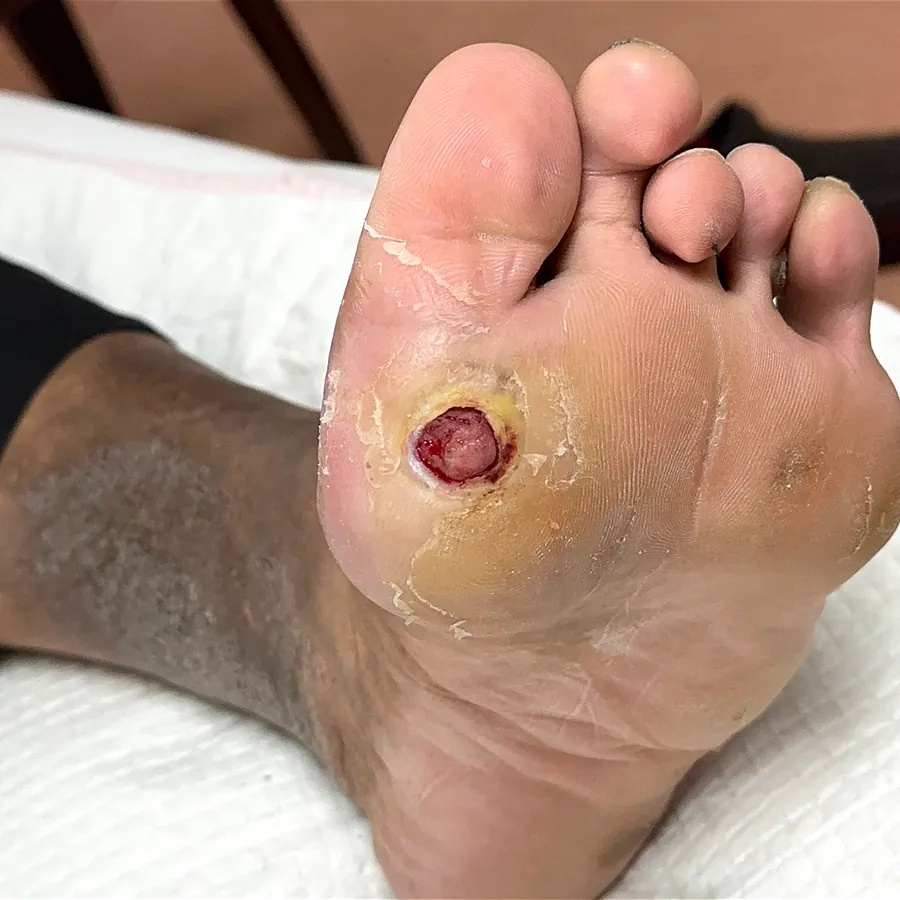 Clinical photograph of a diabetic plantar wound at visit 4, HKL-14