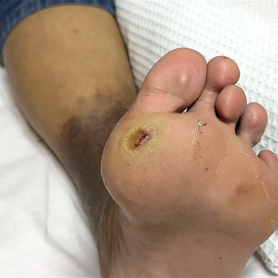 Clinical photograph of a diabetic plantar wound at visit 5, HKL-14