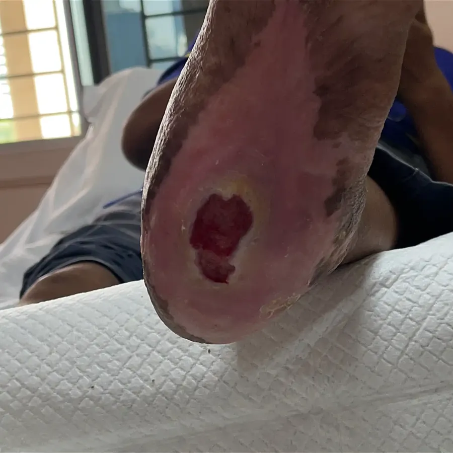 Clinical photograph of a diabetic heel wound at visit 1, HKL-15
