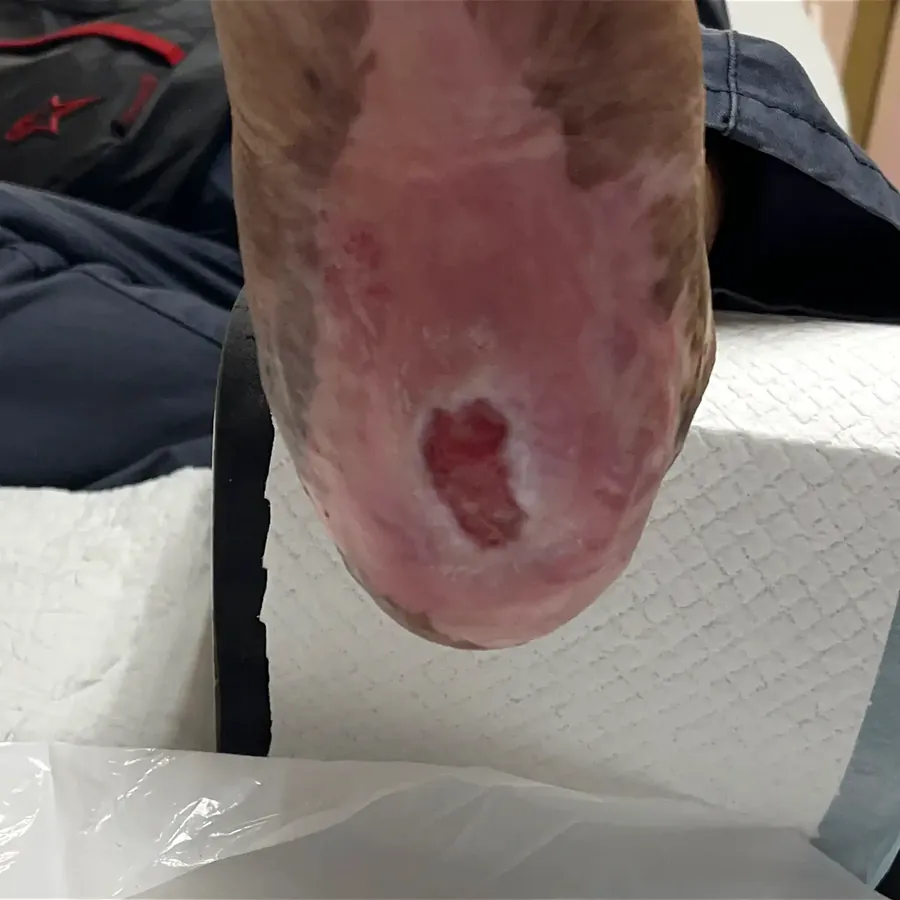Clinical photograph of a diabetic heel wound at visit 2, HKL-15