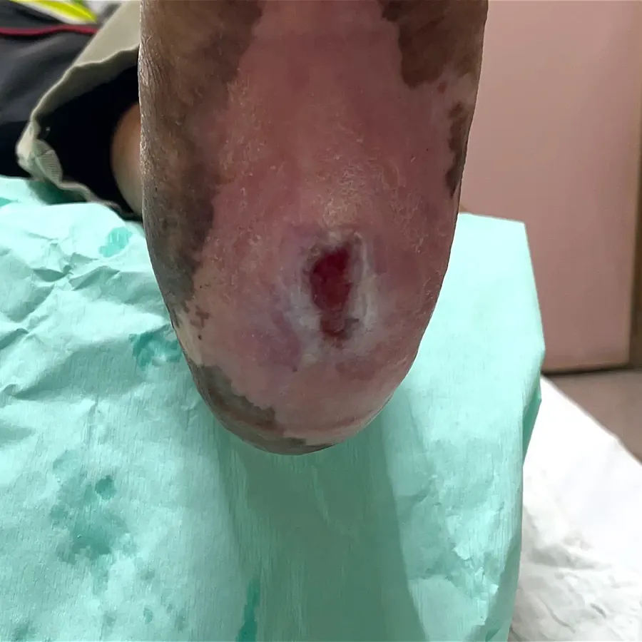 Clinical photograph of a diabetic heel wound at visit 3, HKL-15