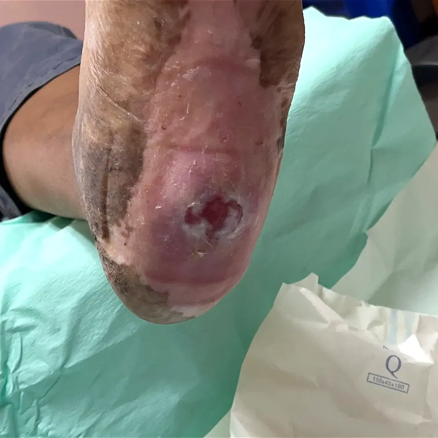 Clinical photograph of a diabetic heel wound at visit 4, HKL-15