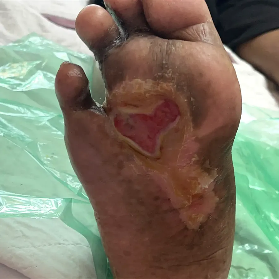 Clinical photograph of a diabetic plantar wound at visit 1, HKL-16