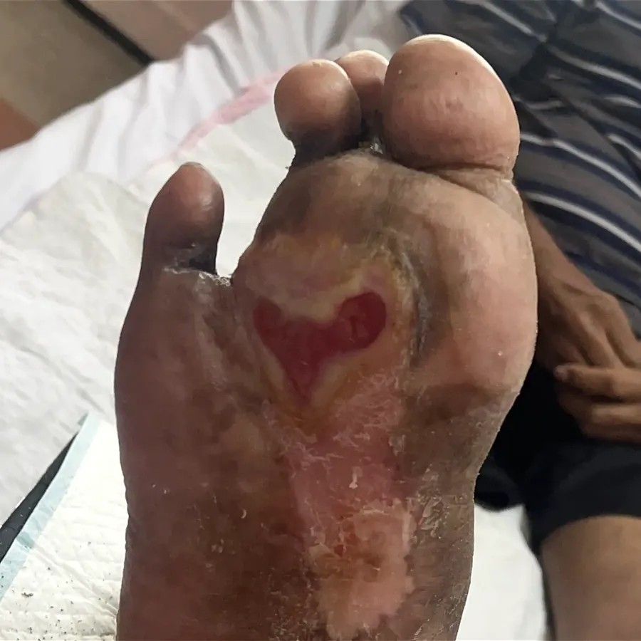 Clinical photograph of a diabetic plantar wound at visit 2, HKL-16