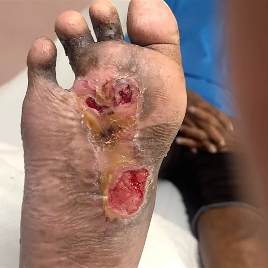 Clinical photograph of a diabetic plantar wound at visit 3, HKL-16