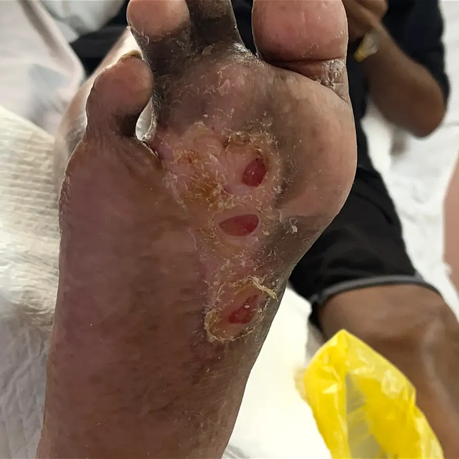 Clinical photograph of a diabetic plantar wound at visit 4, HKL-16