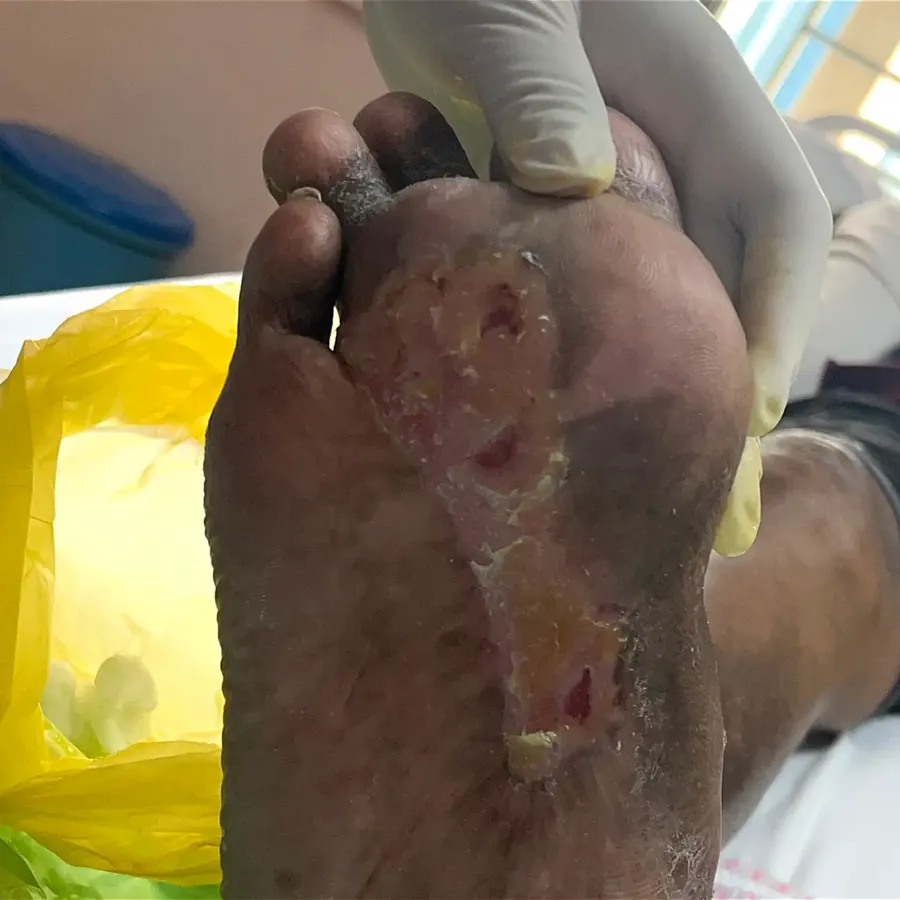 Clinical photograph of a diabetic plantar wound at visit 5, HKL-16