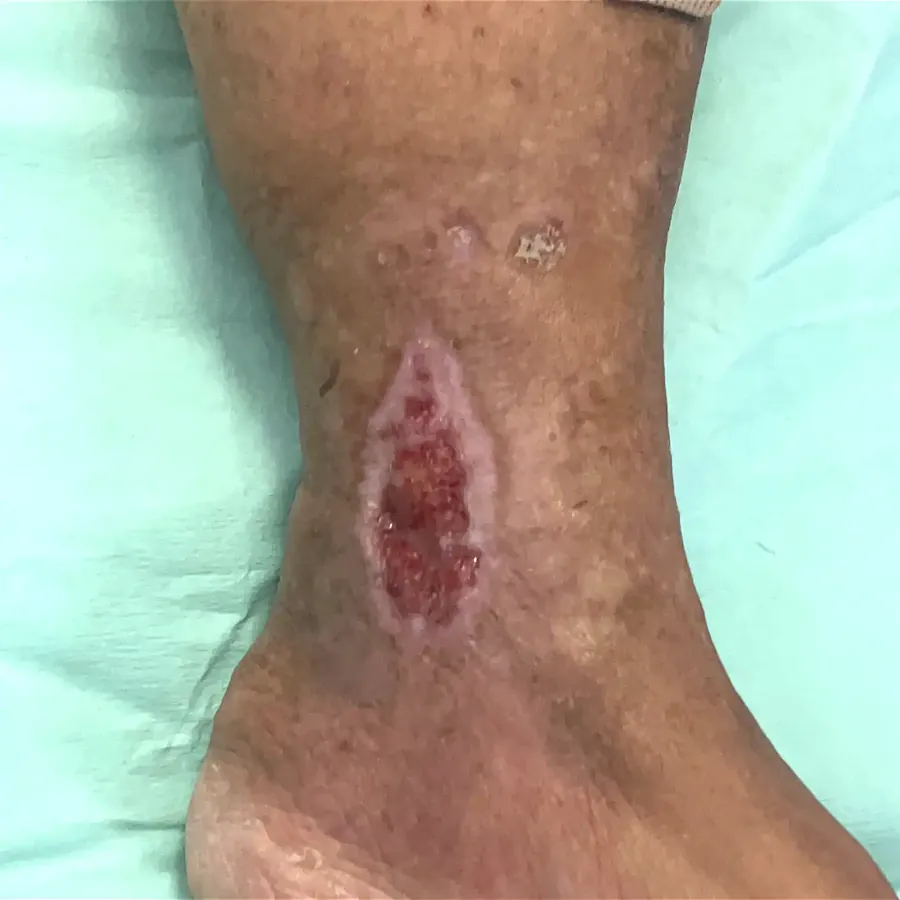 Clinical photograph of a lymphovascular leg wound at visit 1, HKL-17