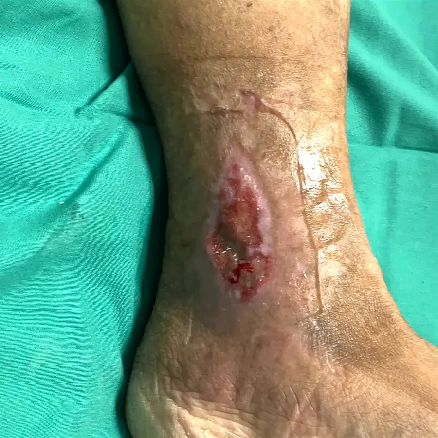Clinical photograph of a lymphovascular leg wound at visit 2, HKL-17