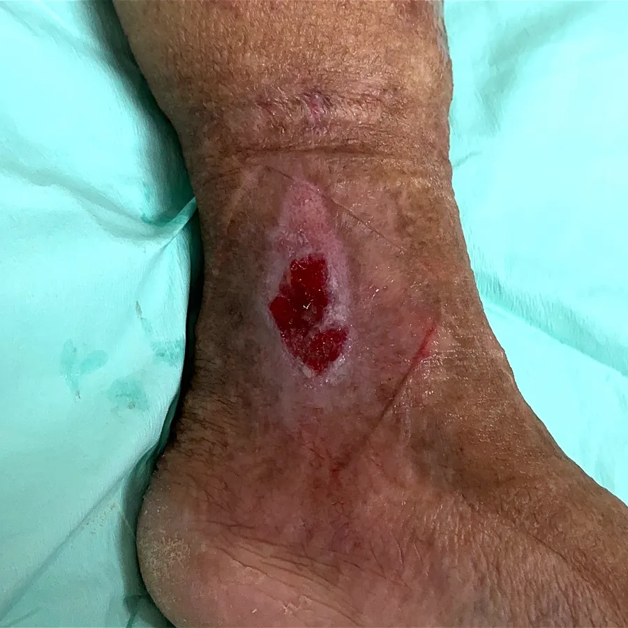 Clinical photograph of a lymphovascular leg wound at visit 3, HKL-17