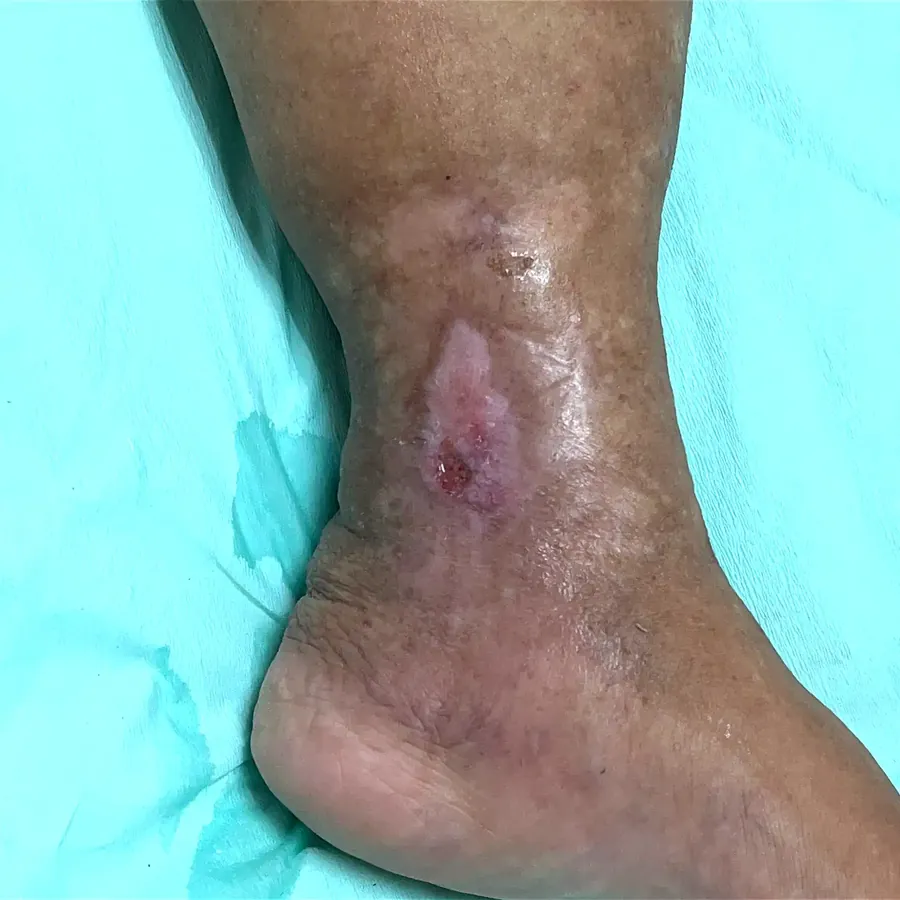 Clinical photograph of a lymphovascular leg wound at visit 4, HKL-17