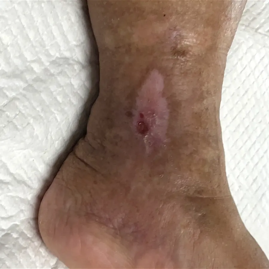 Clinical photograph of a lymphovascular leg wound at visit 5, HKL-17
