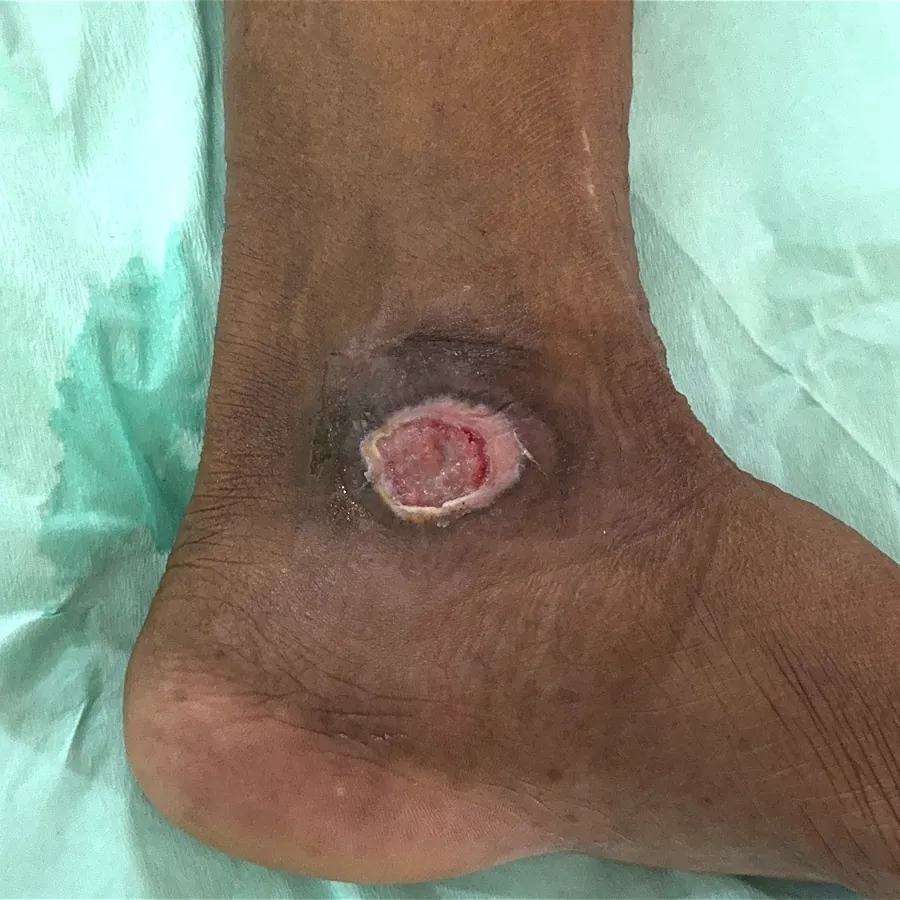 Clinical photograph of a diabetic foot wound at visit 1, HKL-18