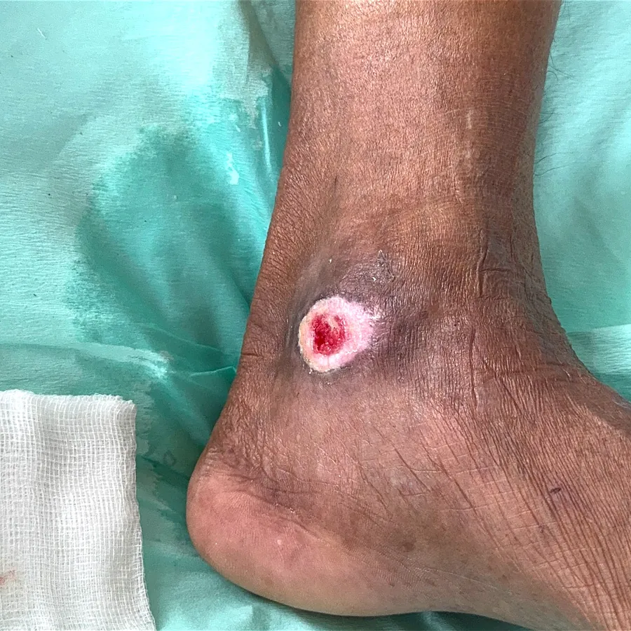 Clinical photograph of a diabetic foot wound at visit 2, HKL-18
