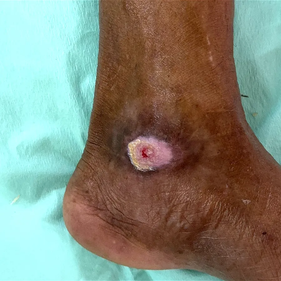 Clinical photograph of a diabetic foot wound at visit 3, HKL-18
