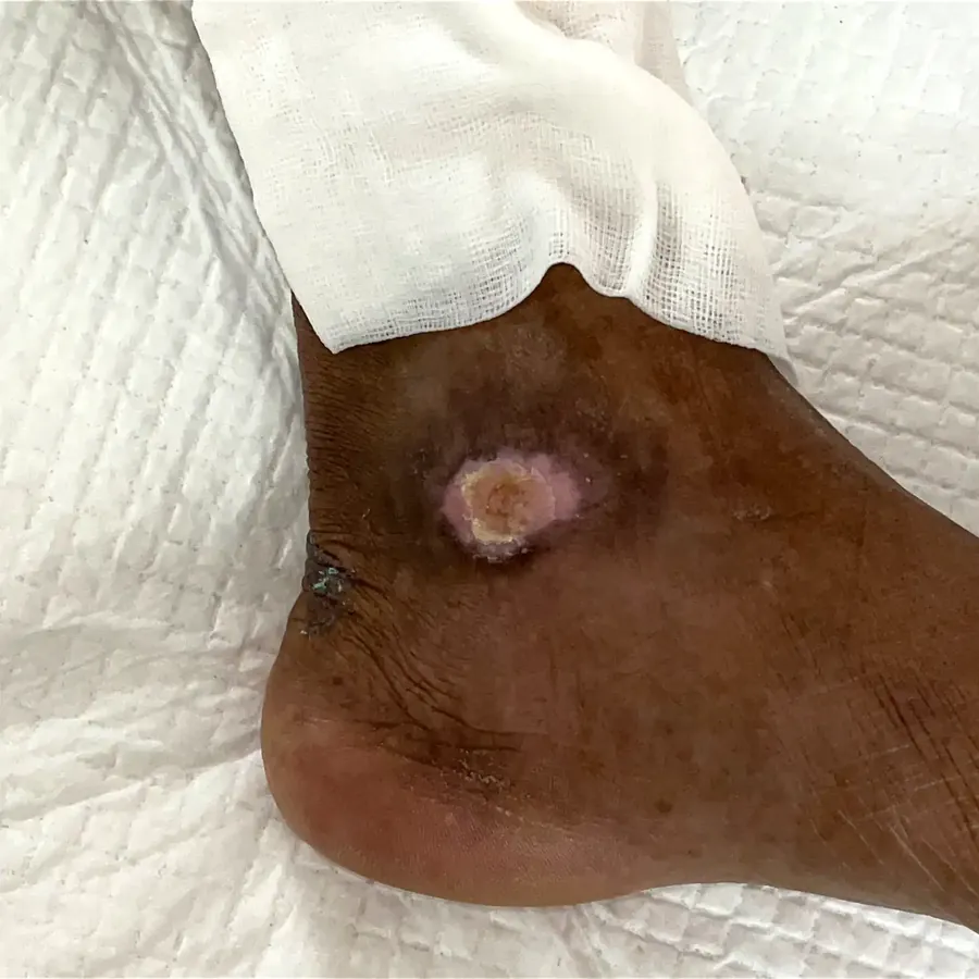 Clinical photograph of a diabetic foot wound at visit 4, HKL-18