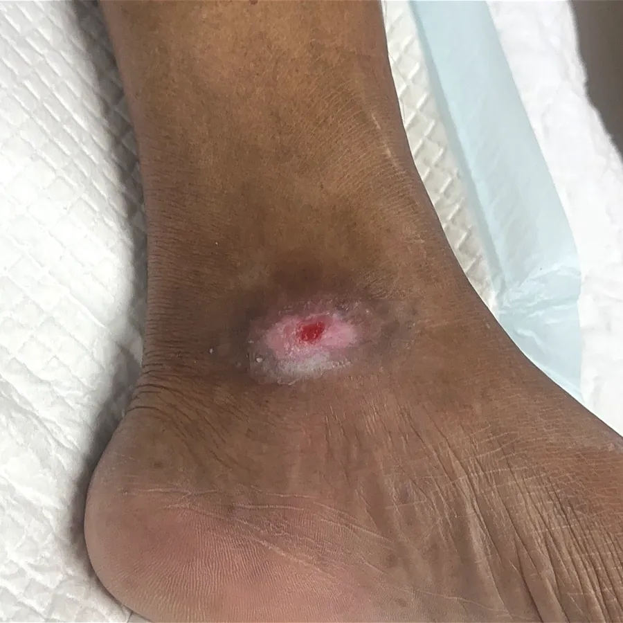 Clinical photograph of a diabetic foot wound at visit 5, HKL-18