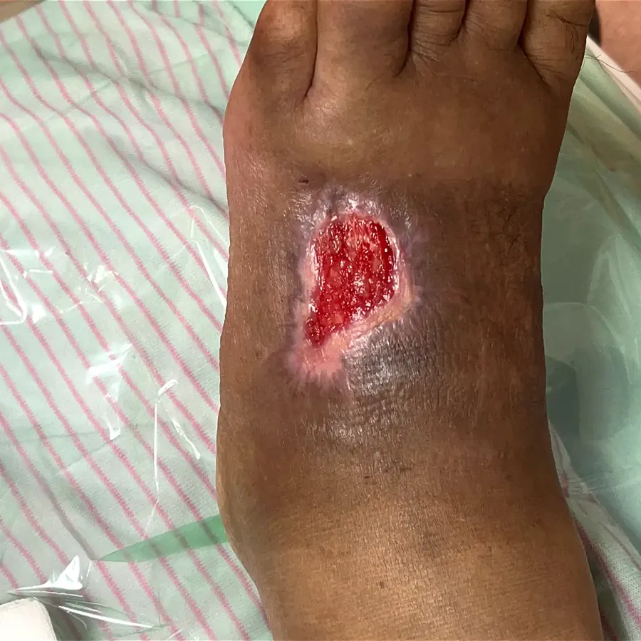 Clinical photograph of a diabetic foot wound at visit 1, HKL-19