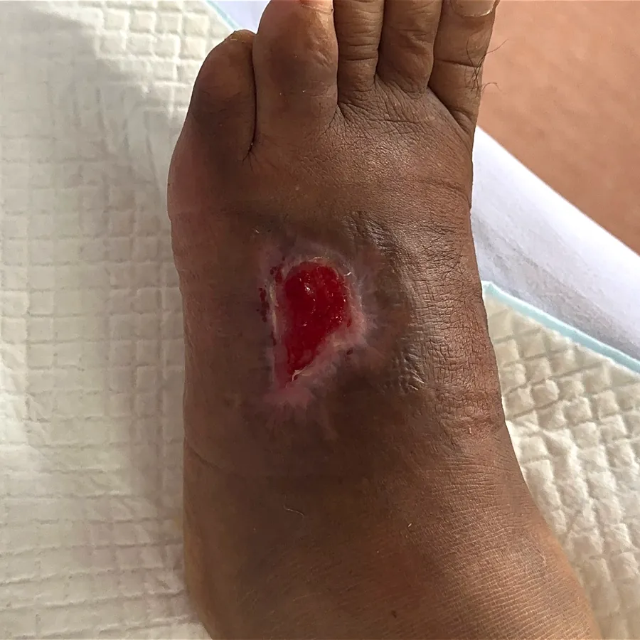 Clinical photograph of a diabetic foot wound at visit 2, HKL-19