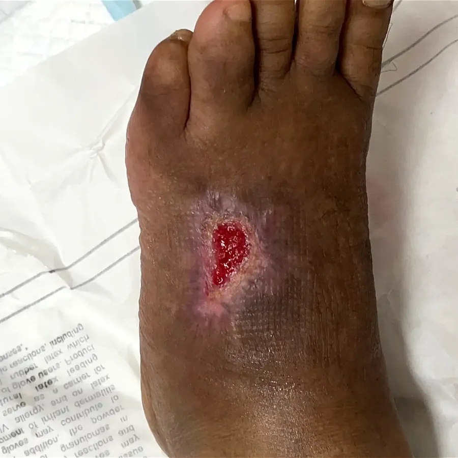Clinical photograph of a diabetic foot wound at visit 3, HKL-19