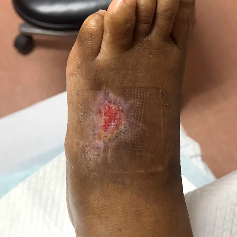Clinical photograph of a diabetic foot wound at visit 4, HKL-19