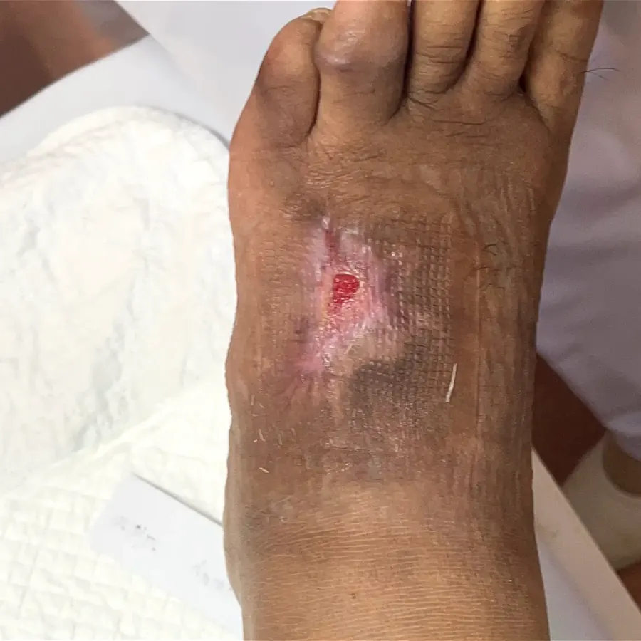 Clinical photograph of a diabetic foot wound at visit 5, HKL-19