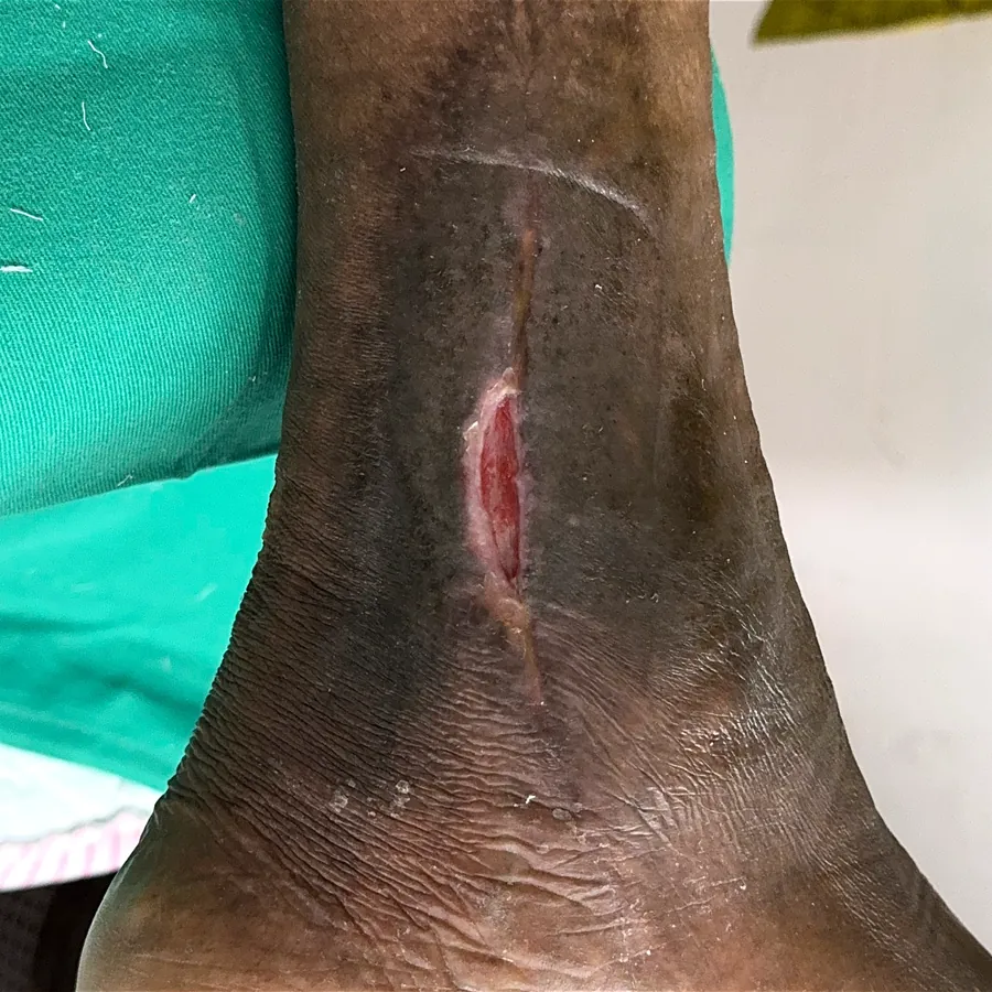Clinical photograph of a lymphovascular leg wound at visit 1, HKL-20