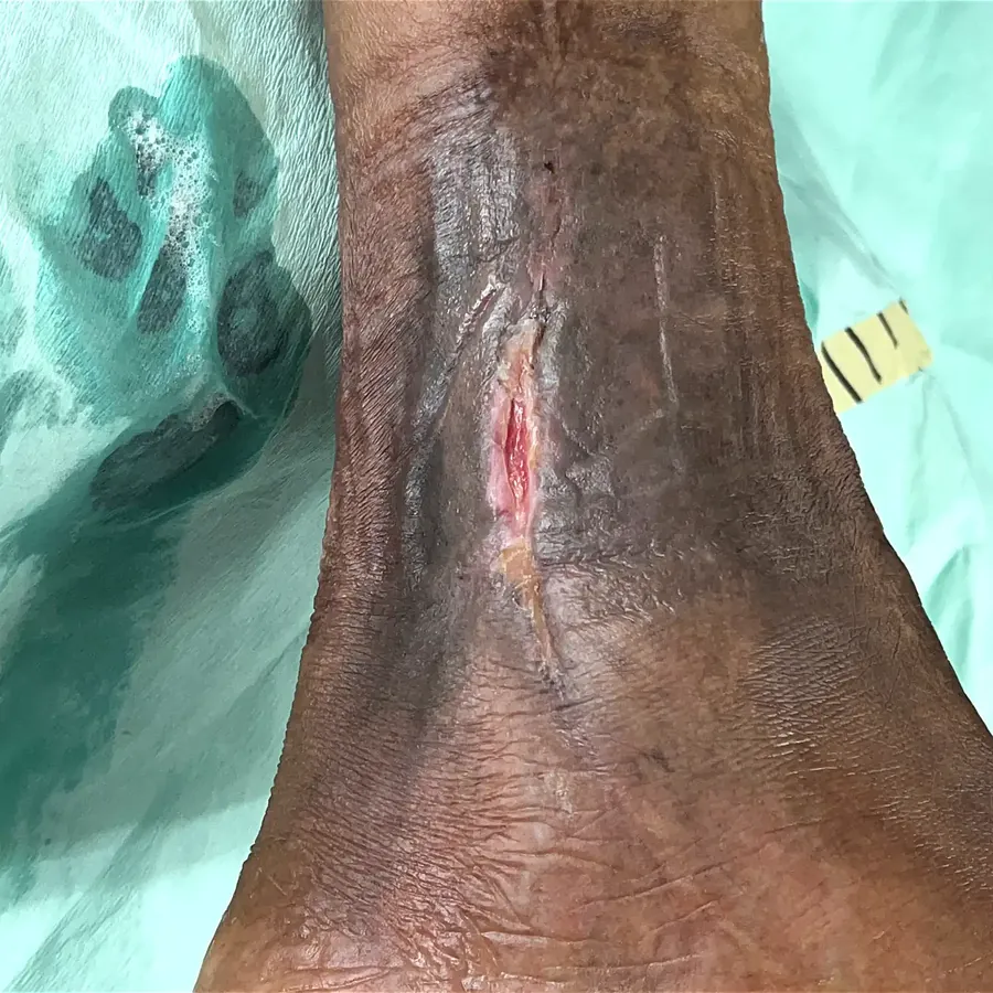 Clinical photograph of a lymphovascular leg wound at visit 2, HKL-20