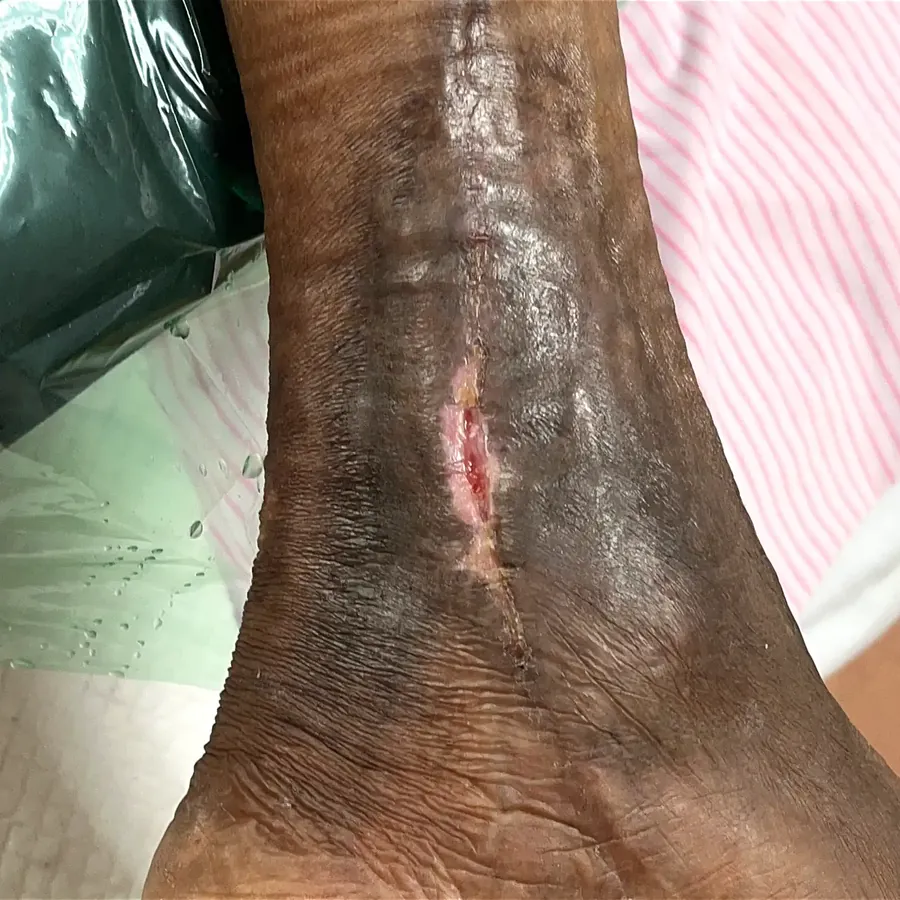 Clinical photograph of a lymphovascular leg wound at visit 3, HKL-20