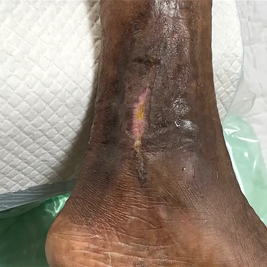 Clinical photograph of a lymphovascular leg wound at visit 4, HKL-20