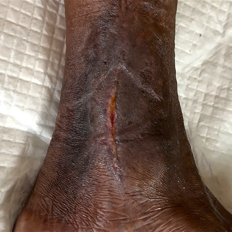 Clinical photograph of a lymphovascular leg wound at visit 5, HKL-20