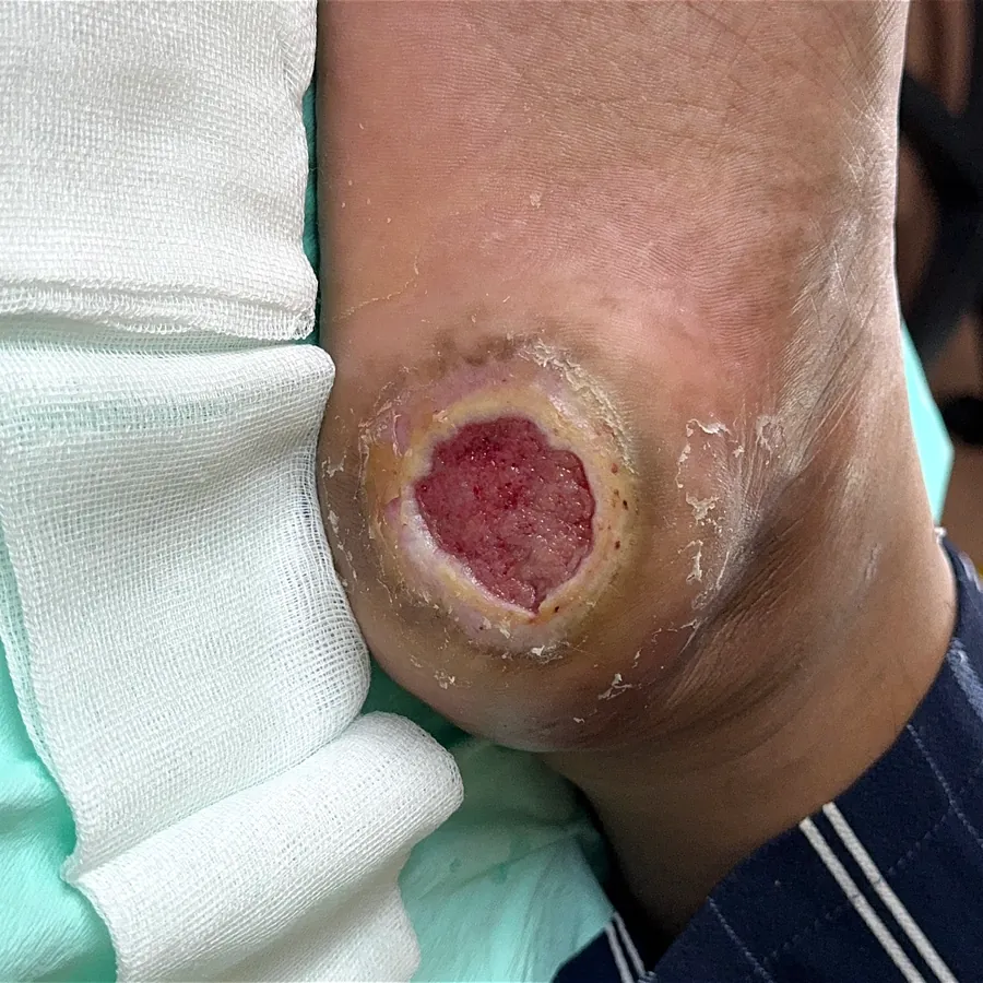 Clinical photograph of a diabetic heel wound at visit 1, HKL-21