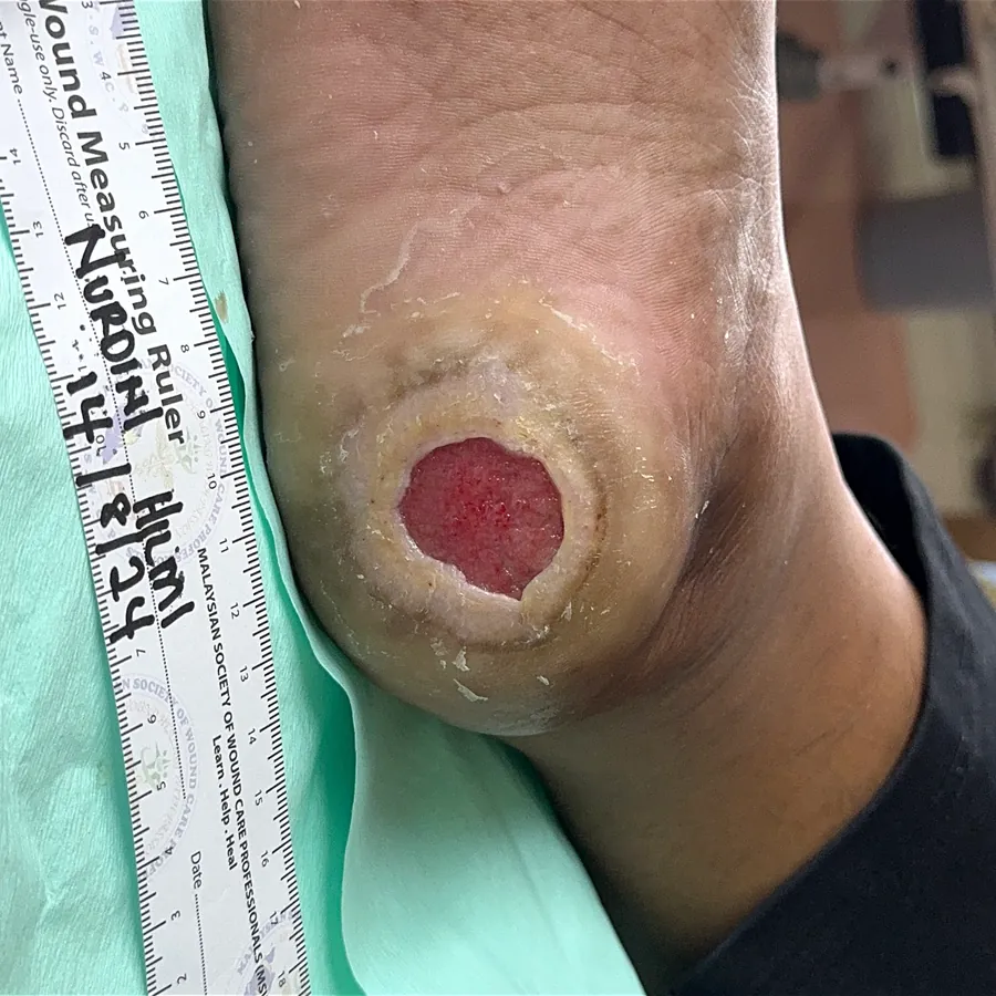 Clinical photograph of a diabetic heel wound at visit 2, HKL-21